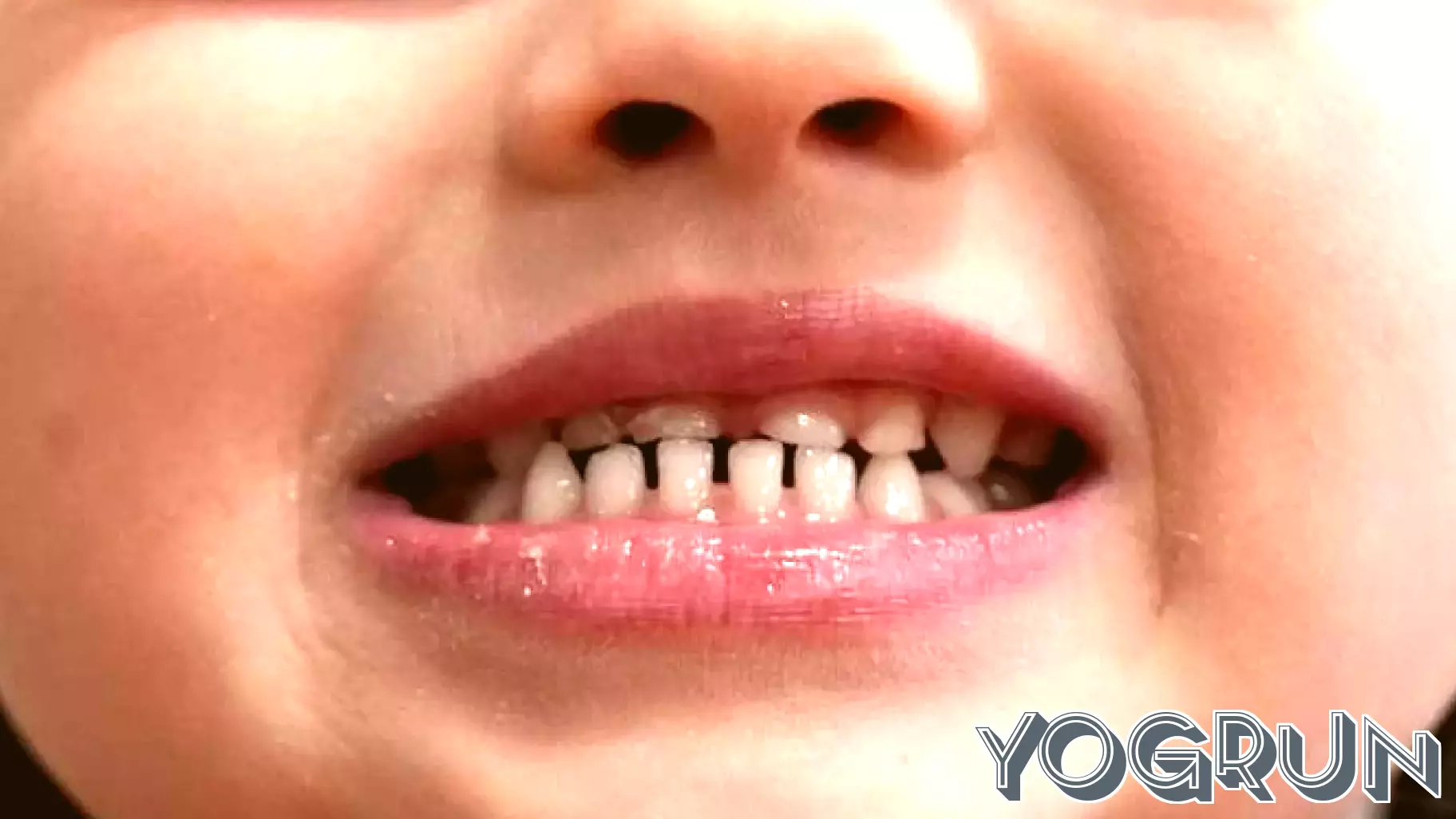 FDA Imposes Restrictions on Fluoride Supplements for Children