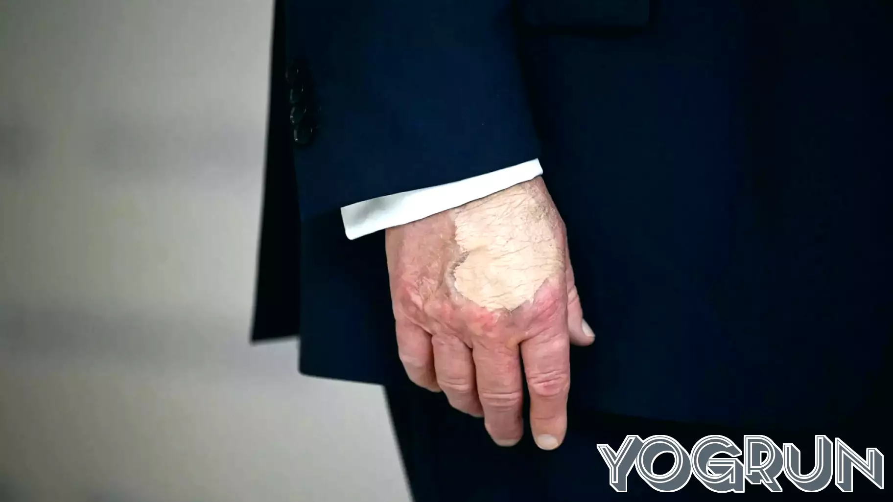 President Trump’s Health: Concerns Over Bruises on His Hand