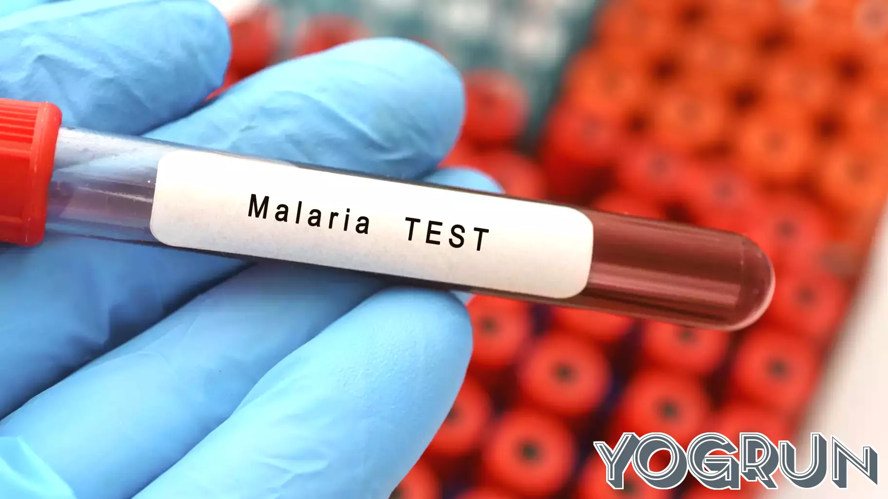 Unexplained Malaria Case in New Jersey Raises Concerns