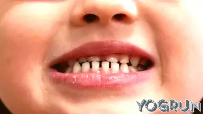 FDA Imposes Restrictions on Fluoride Supplements for Children