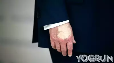 President Trump’s Health: Concerns Over Bruises on His Hand